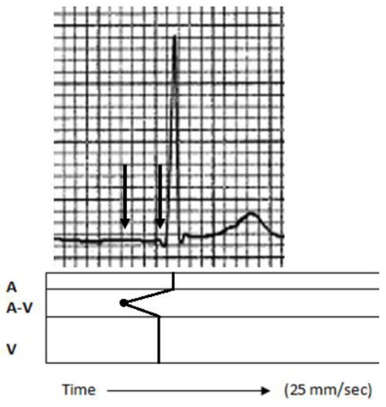 All About Junctional Beats Advanced ECG Courses