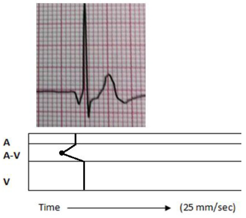 All About Junctional Beats Advanced ECG Courses