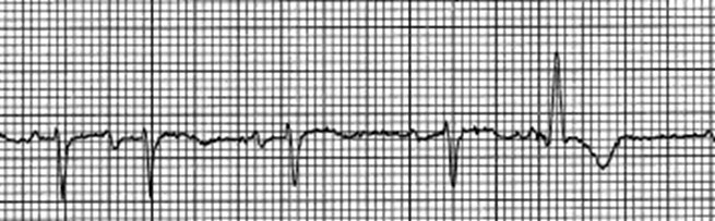 Ashman-Gouaux Phenomenon with aberrantly conducted beat