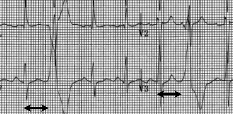 Coupling Intervals