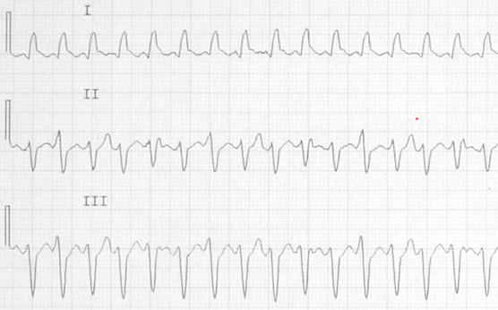ECG - Ventricular Tachycardia