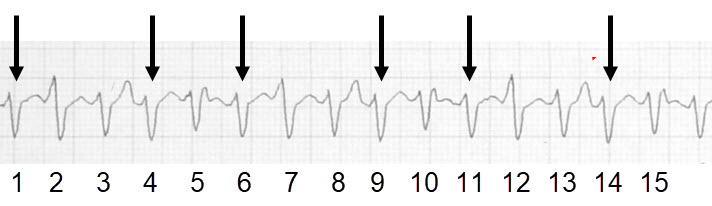 Demonstrating AV dissociation during ventricular tachycardia
