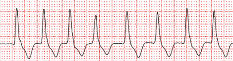 Fusion beat during ventricular tachycardia