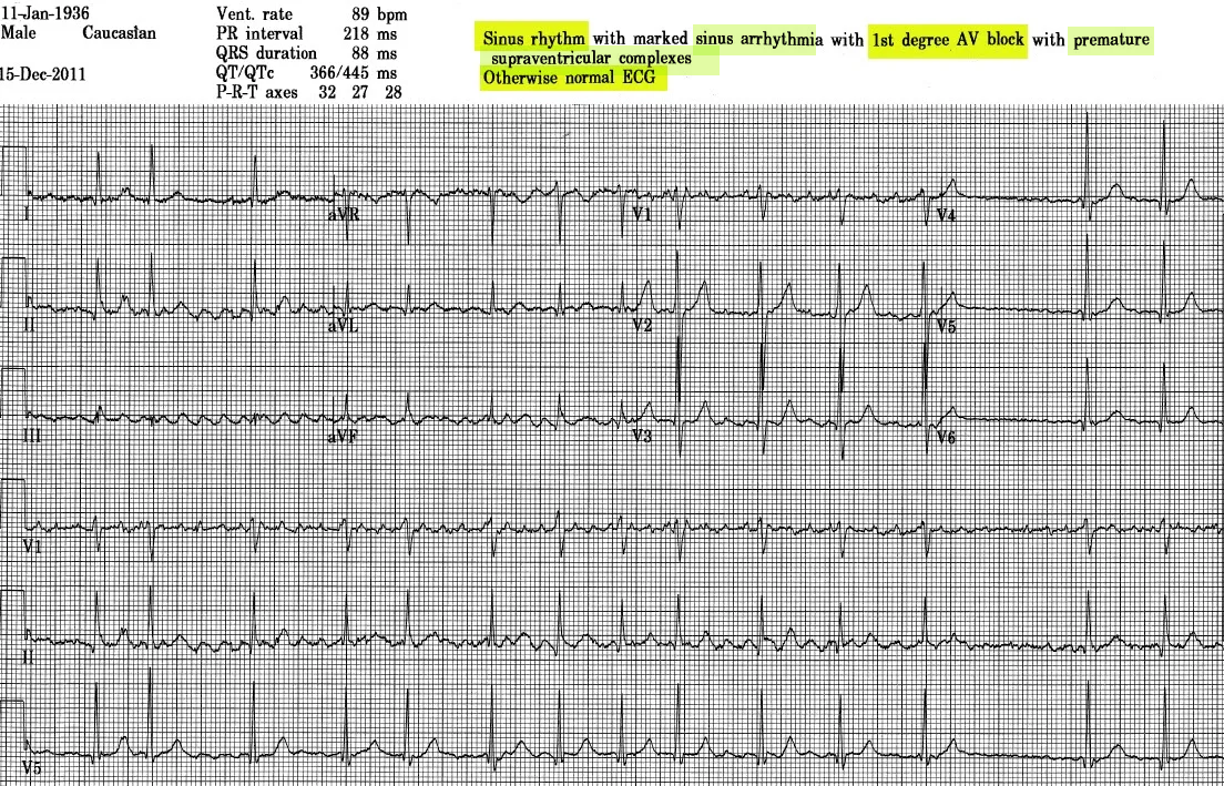 Atrial fibrillation