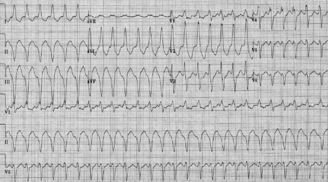 Ventricular Tachycardia