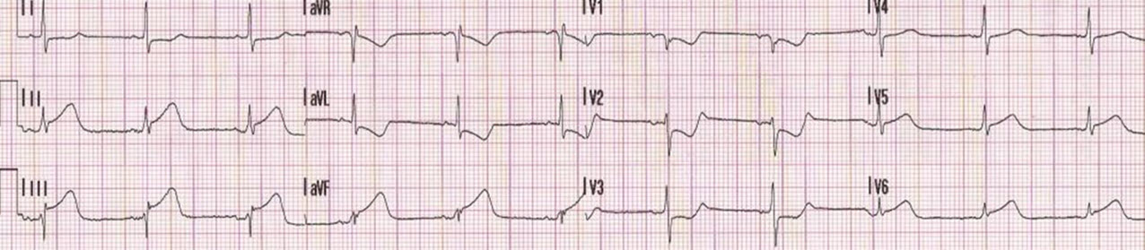 Reciprocal changes with upright T waves